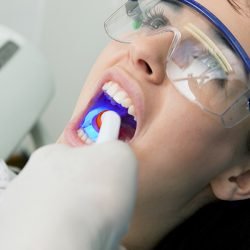 Dental Fillings